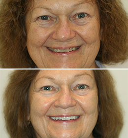 A womans mouth and teeth discolored and then white after treatment from Brad Pitts Family & Cosmetic Dentistry