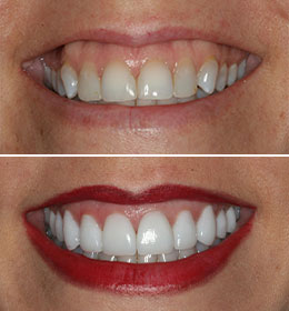 A womans mouth and teeth before and after treatment from Brad Pitts Family & Cosmetic Dentistry