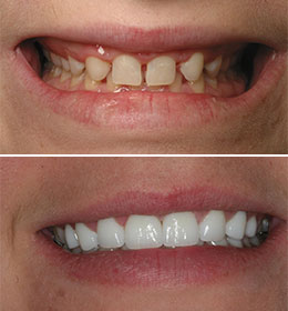 The mouth of a patient with teeth problems before and after treatment from Brad Pitts Family & Cosmetic Dentistry
