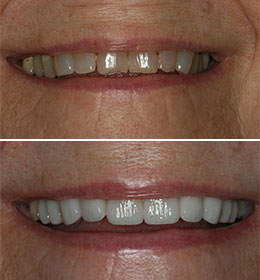 A mouth and teeth with issues before and after treatment from Brad Pitts Family & Cosmetic Dentistry