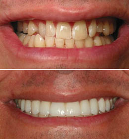 The before and after images of a man who was treated by Brad Pitts Family & Cosmetic Dentistry