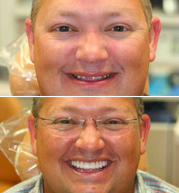 The teeth and mouth situation of a man before and after treatment from Brad Pitts Family & Cosmetic Dentistry